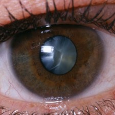 Cataracts vs Dirty Lenses?